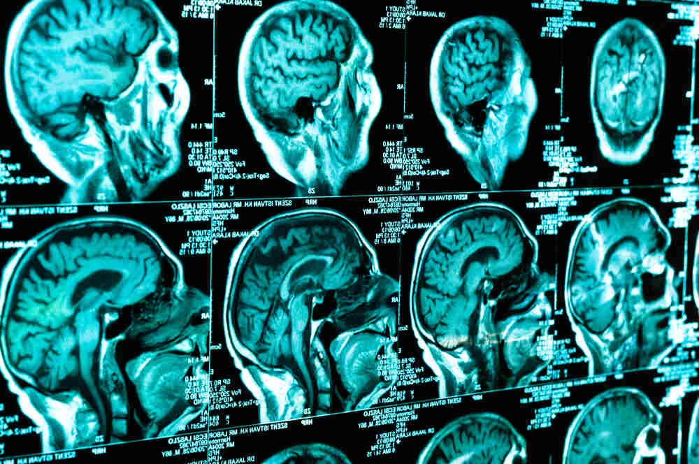Traumatic Brain Injuries CT Scan