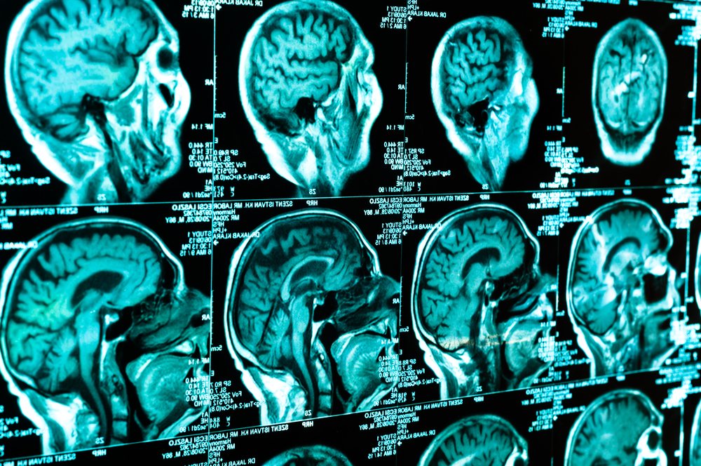 Traumatic Brain Injury Laws