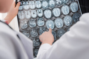 traumatic brain injury and types of cases they handle
