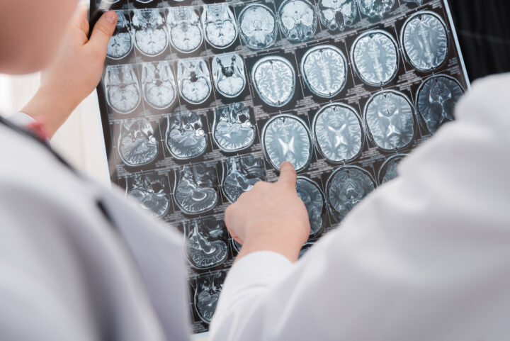 When to Hire a Traumatic Brain Injury Attorney